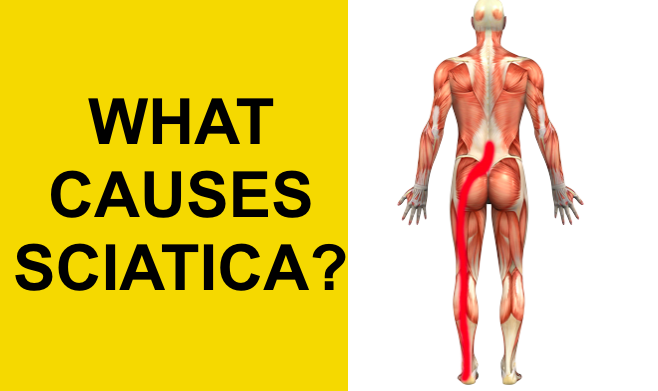 Top Sciatica Causes Symptoms And Treatment The Pain Free Institute