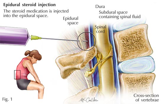 epidural injection sciatica