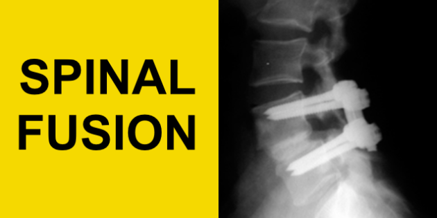 Why spinal fusion is not recommended?