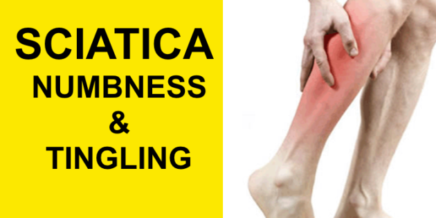 sciatica numbness and tingling