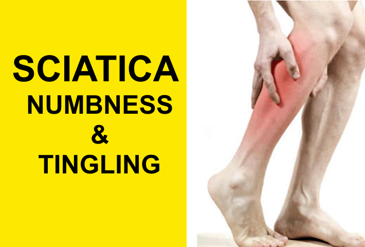 Sciatic Nerve Causing Tingling In Feet